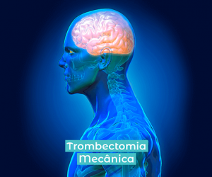 O que é trombectomia mecânica?