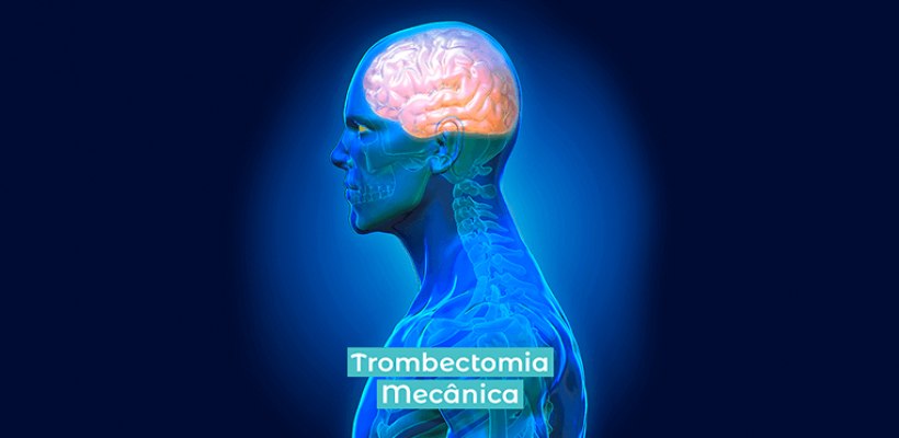 O que é trombectomia mecânica?